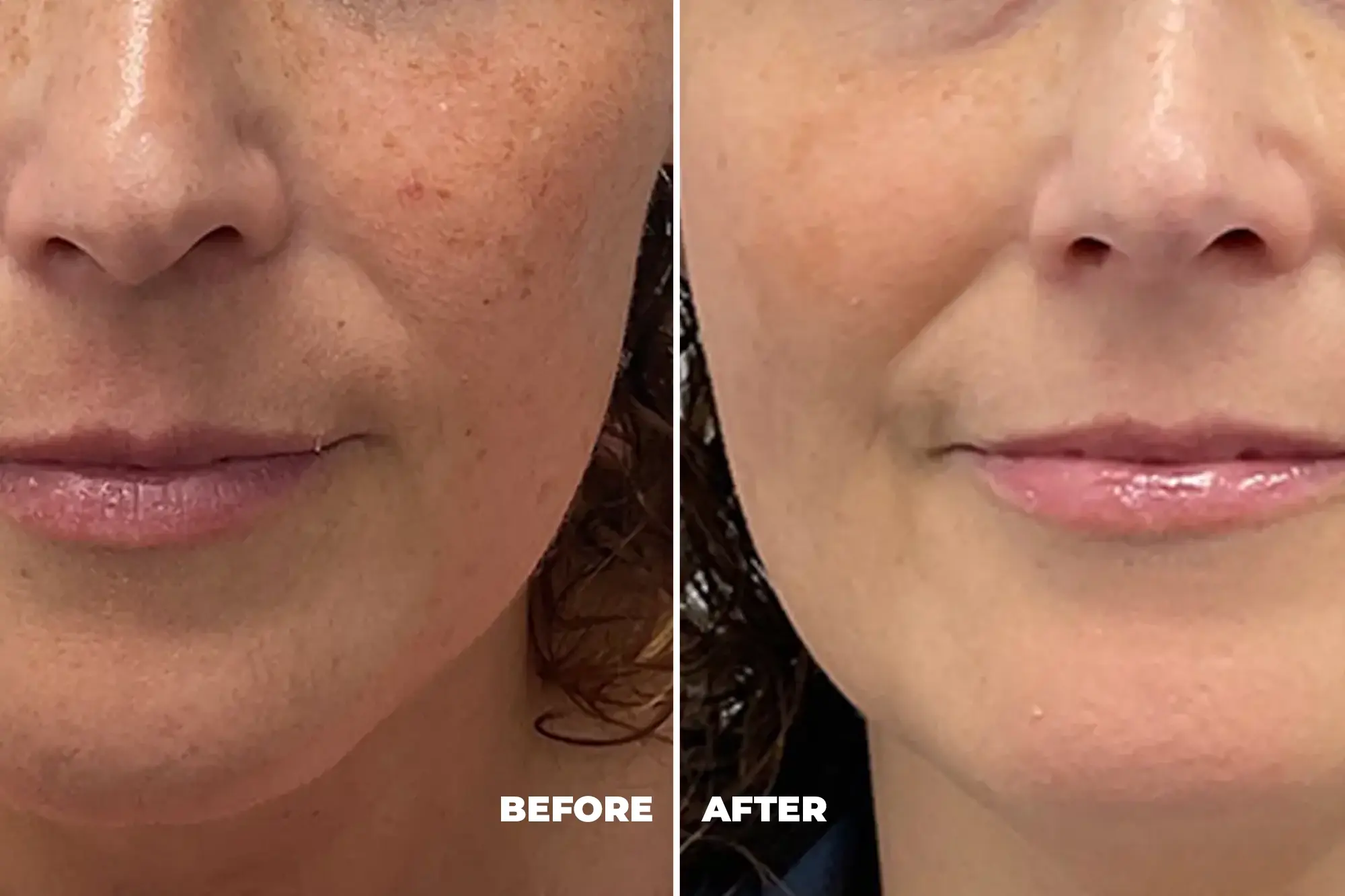 Morpheus8 RF microneedling treatment for skin tightening and body contouring at RevivaBala Med Spa