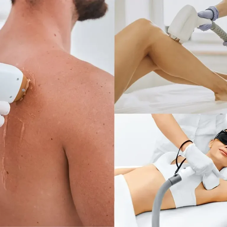 Advanced laser hair removal treatment on back, legs, and underarms using painless latest laser technology for full body hair reduction.